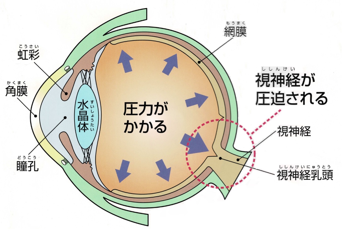 緑内障の治療 | ゆり眼科クリニック